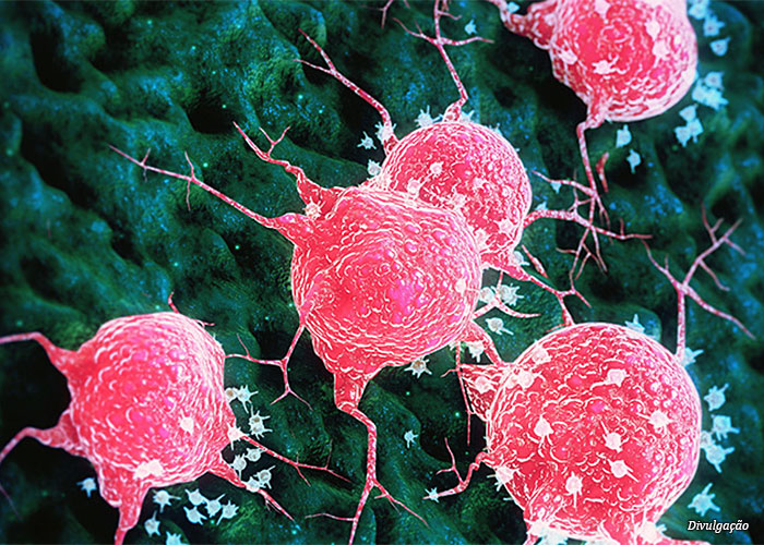 tumor-de-mama