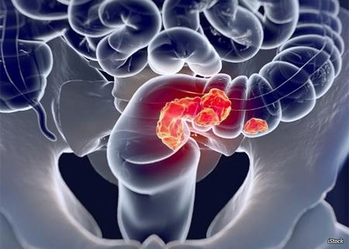 tumor-intestinal